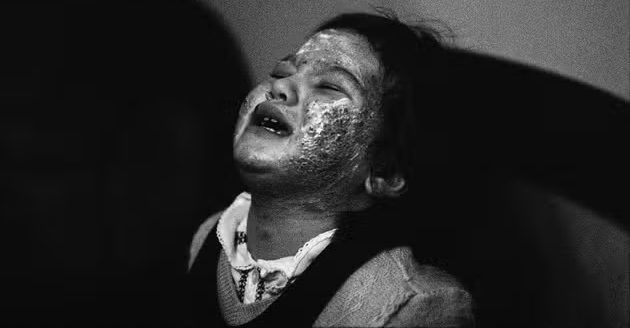 Child with chloracne after the dioxin release in Seveso